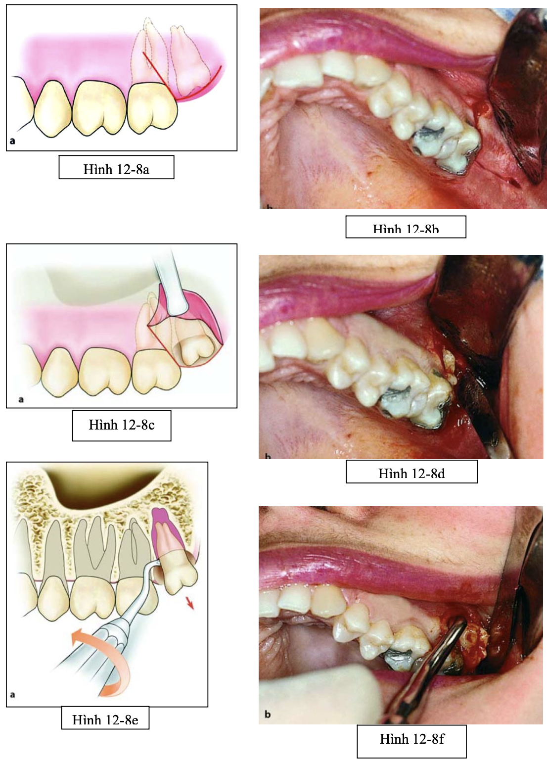 Tiểu phẫu răng khôn hàm trên